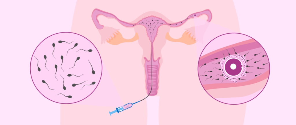 Inseminação Artificial