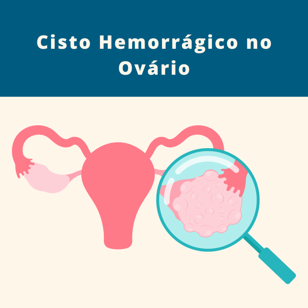 Tratamento Cisto Hemorragico no Ovario