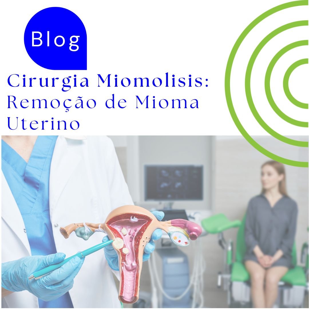 Cirurgia De Miomolisis: Remoção De Mioma Uterino